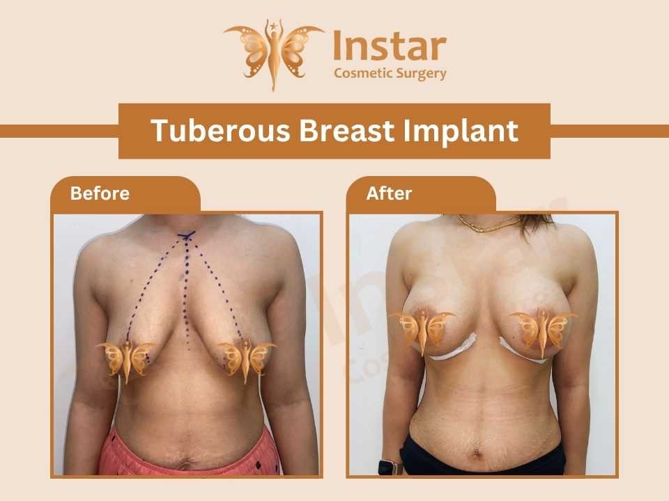 Tuberous-Breast-Implant