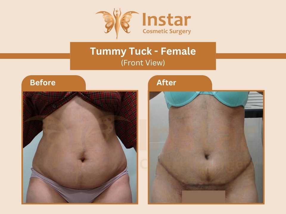 Tummy-Tuck-Female-Front-View