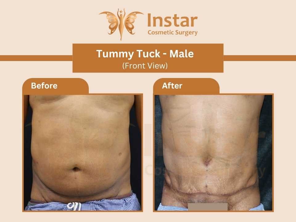 Tummy-Tuck-Male-Front-View