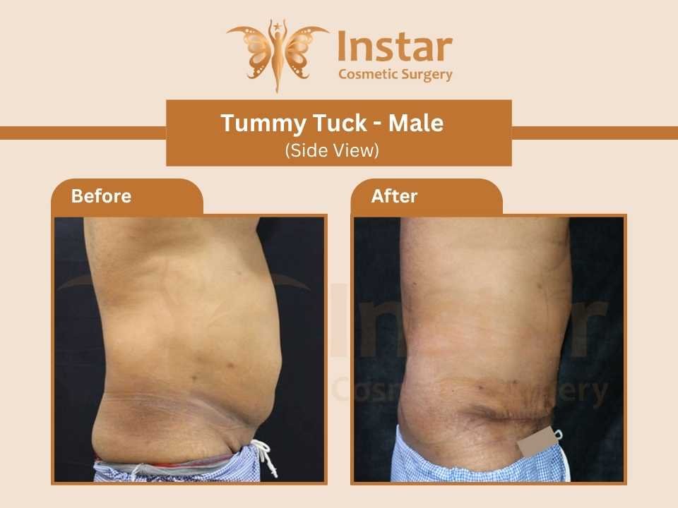 Tummy-Tuck-Male-Side-View