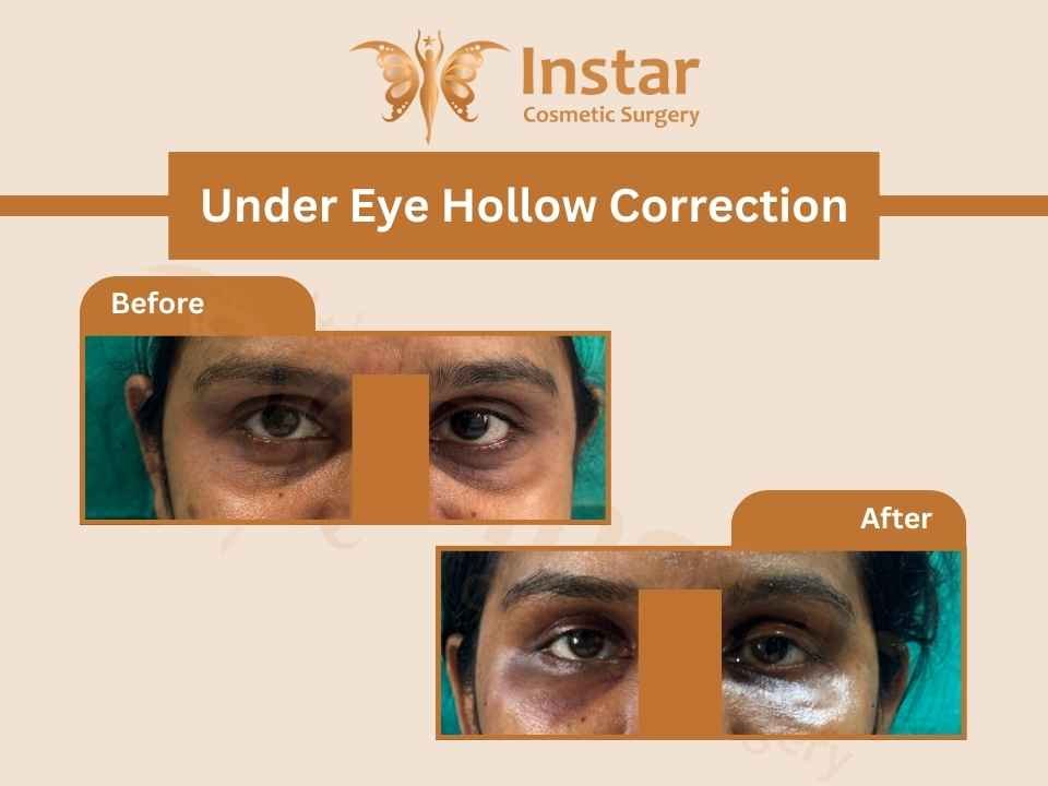 Under-Eye-Hollow-Correction-1
