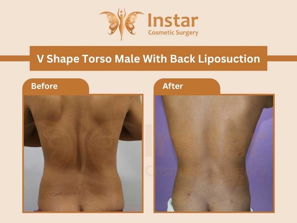 V-shape-torso-male-with-back-liposuction