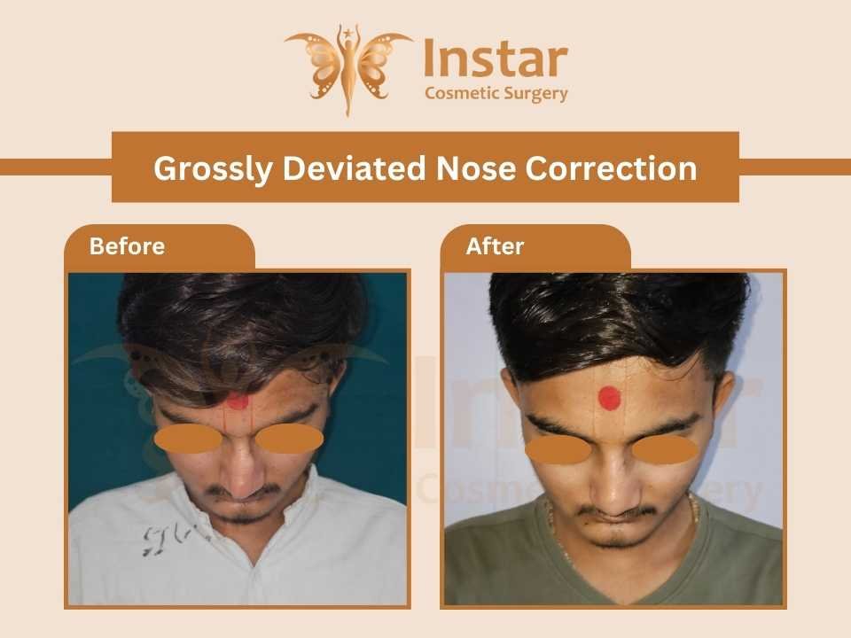 grossly-deviated-nose-correction