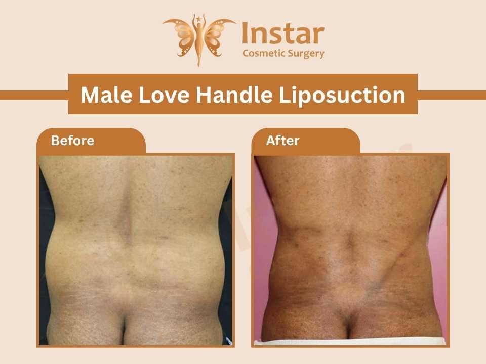 male-love-handle-liposuction