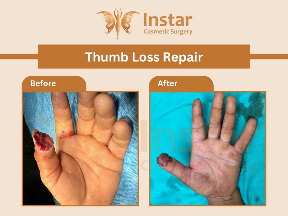 thumb-loss-repair-2