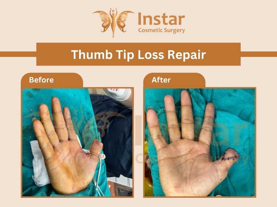 thumb-tip-loss-repair